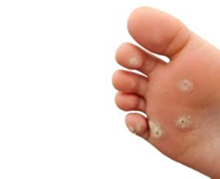 The Mole Clinic foot blister diagram 