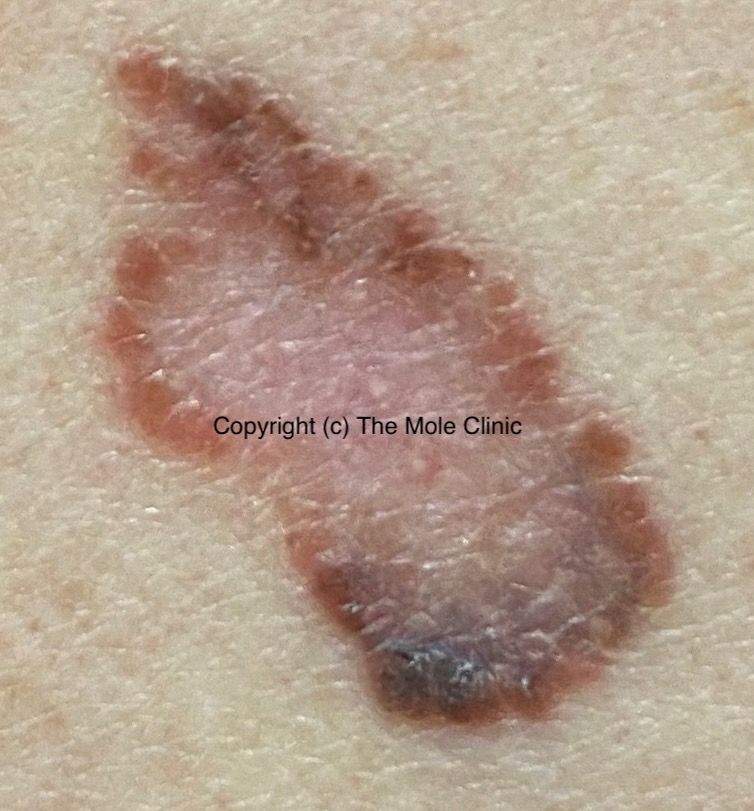 Melanoma Skin Cancer