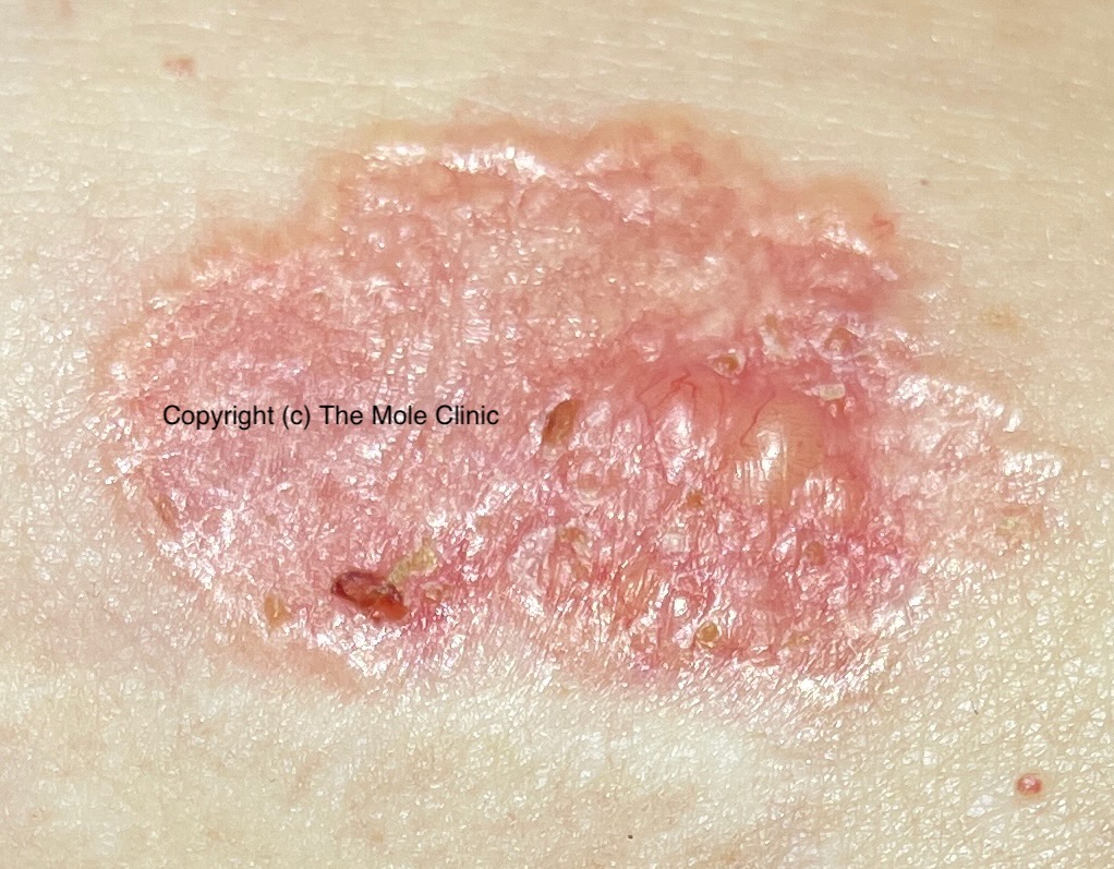 Melanoma Skin Cancer