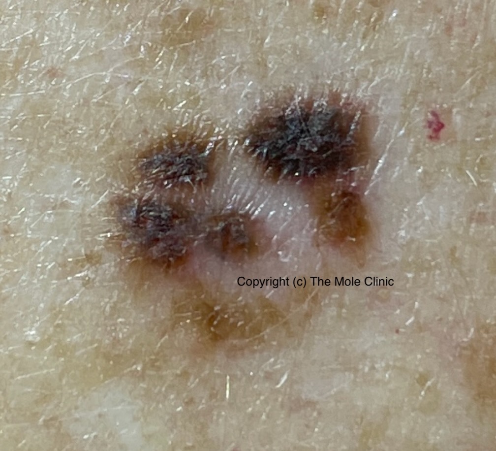 Melanoma Skin Cancer