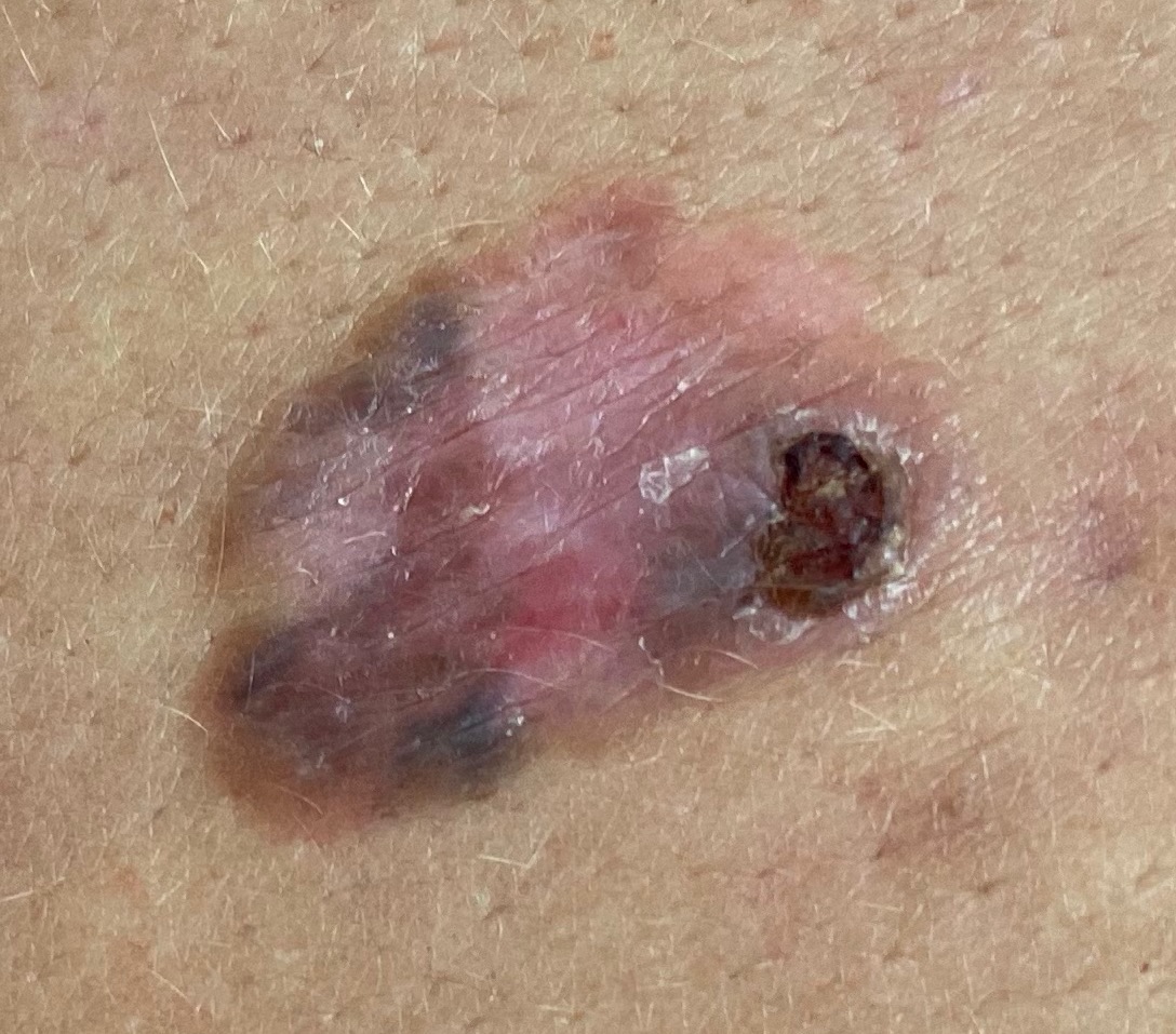 Melanoma Skin Cancer